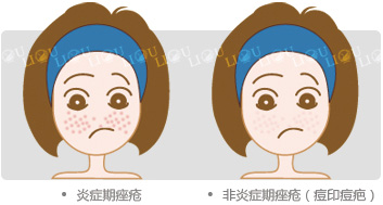 炎症期痤疮