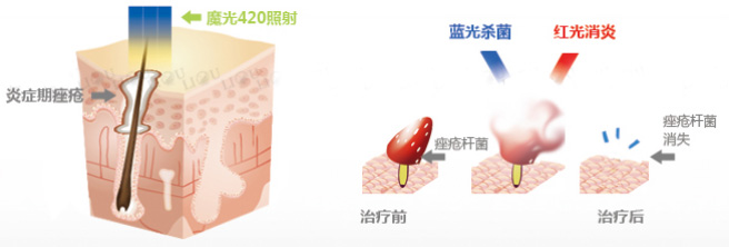 激光治疗痤疮说明图