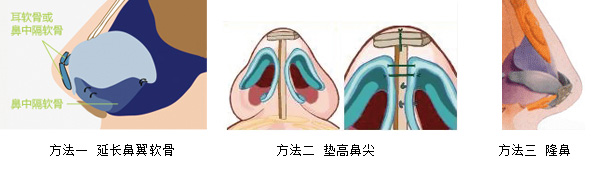 朝天鼻矫正