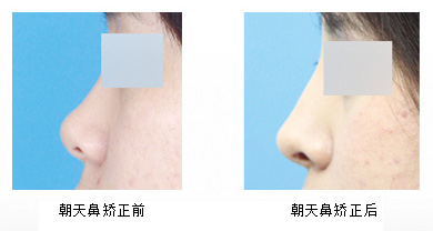 朝天鼻矫正效果