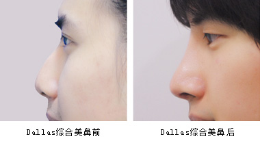 隆鼻前后对比图
