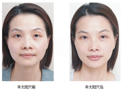 玻尿酸丰太阳穴
