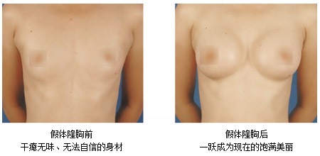苏州丰胸