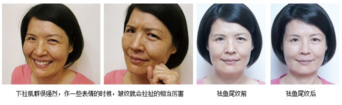 祛鱼尾纹效果