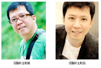 无创溶脂效果