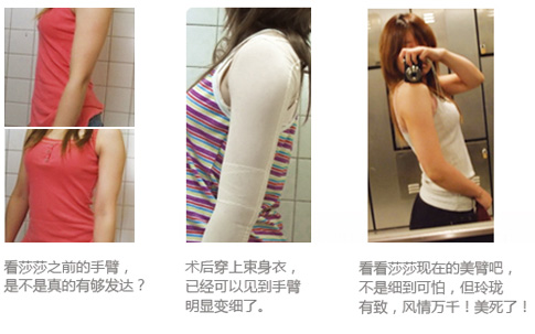 手臂吸脂效果图
