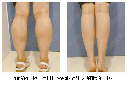 瘦腿针效果图