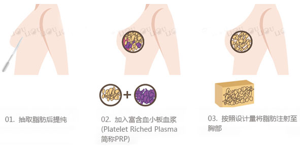 自体脂肪丰胸