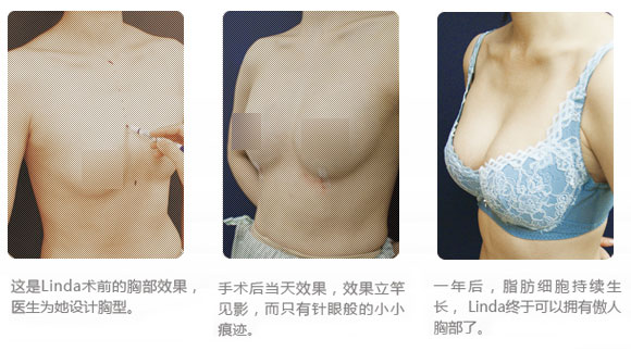 自体脂肪隆胸效果